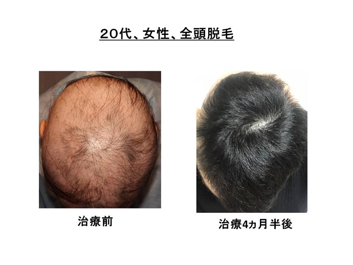 円形脱毛症　病院""